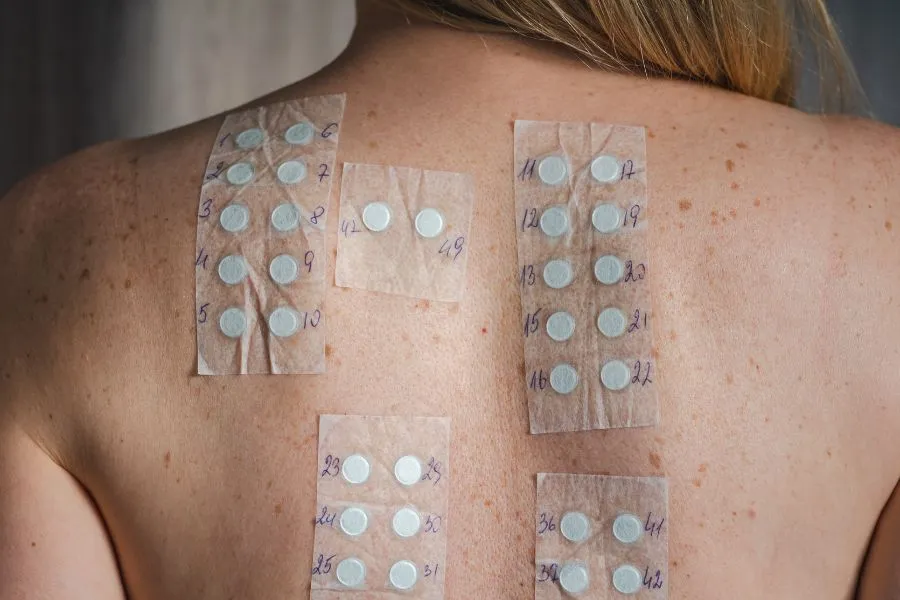 woman's back with test strips for skin reaction testing